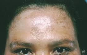 melasma, problemas de pele pós-parto, problemas de pele pós-parto, acne pós-parto